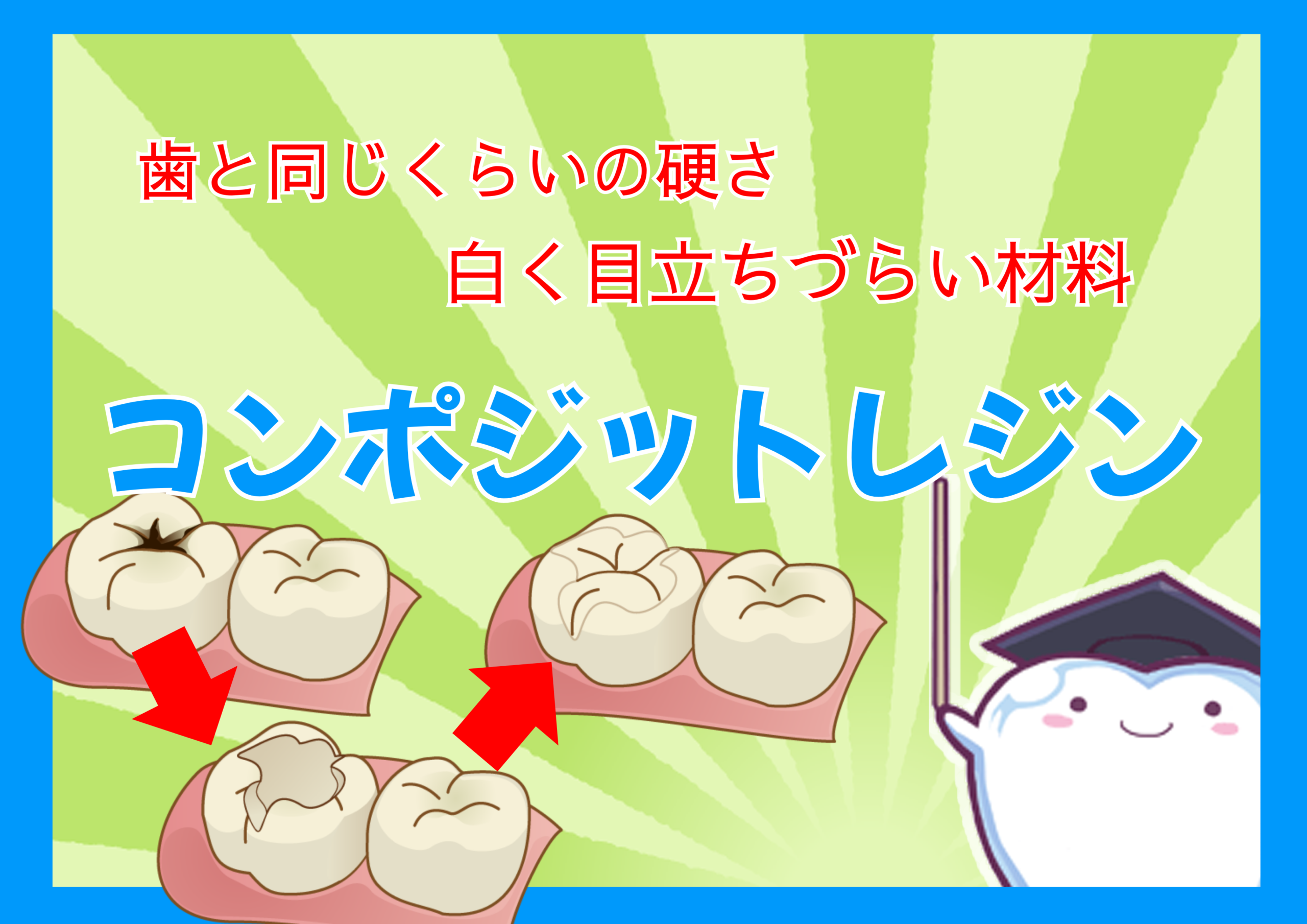 コンポジットレジンのアイキャッチ